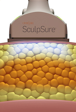 how sculpsure body contouring works - damaging fat cells